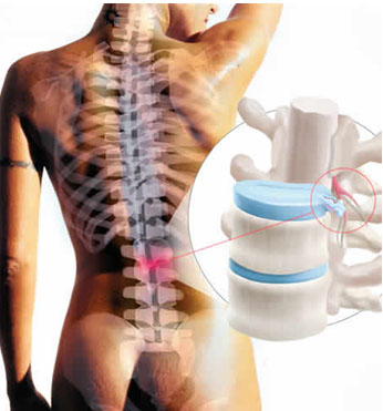 hernia